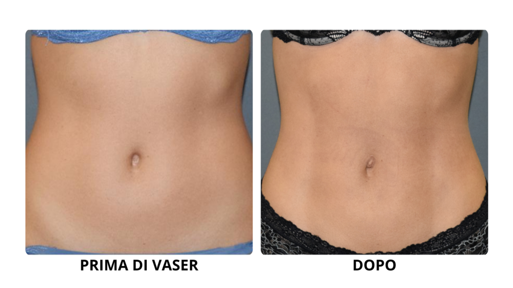Vaser - prima e dopo donna