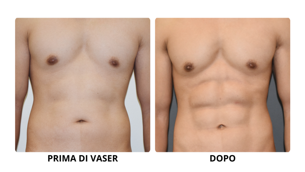 Vaser - prima e dopo uomo